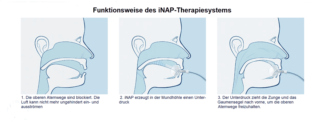 Was ist von der iNAP-Therapie zu halten? 1 Funktionsweise iNAP-Therapie